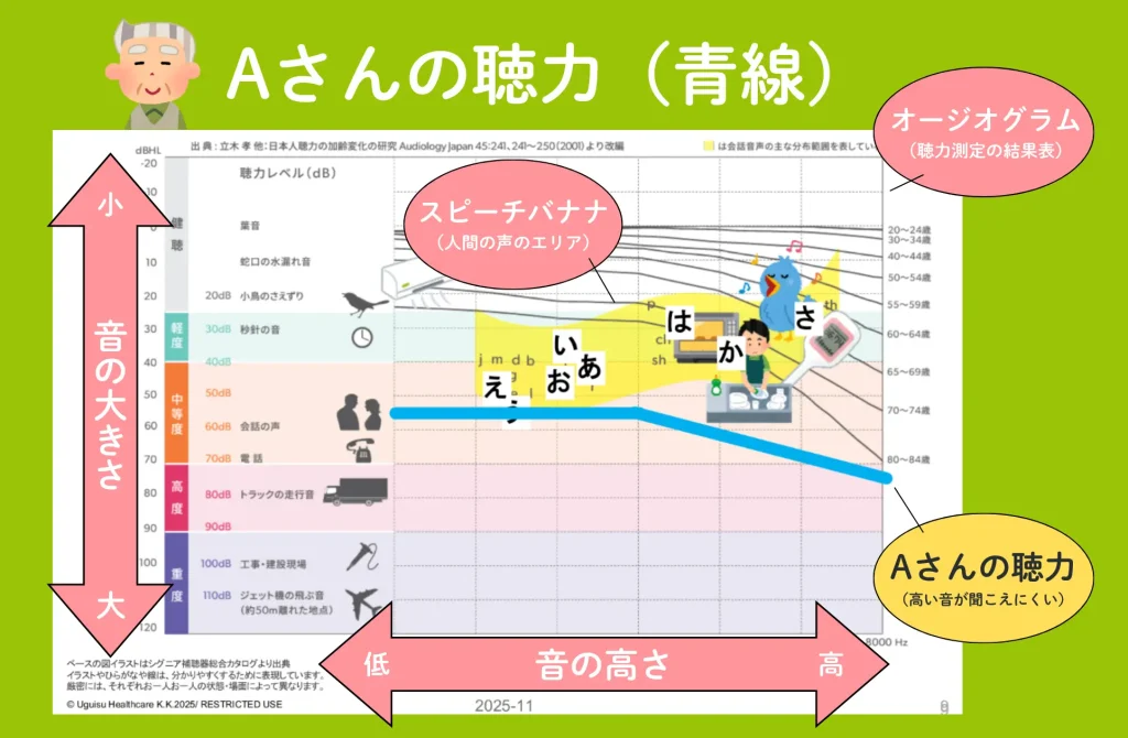 Aさんの聴力を表したオージオグラムの表（高音が聞こえにくい）